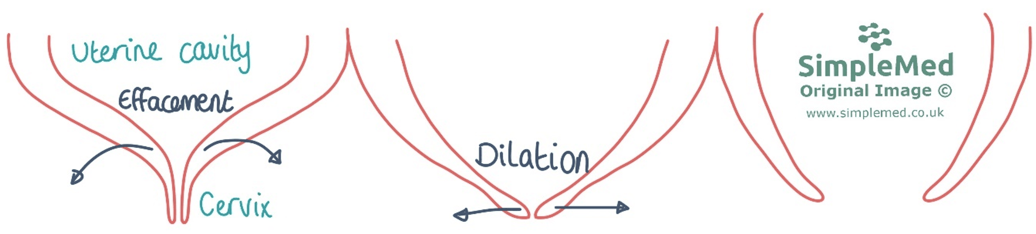 Cervical Effacement and Dilation SimpleMed Cervical Effacement and Dilation SimpleMed