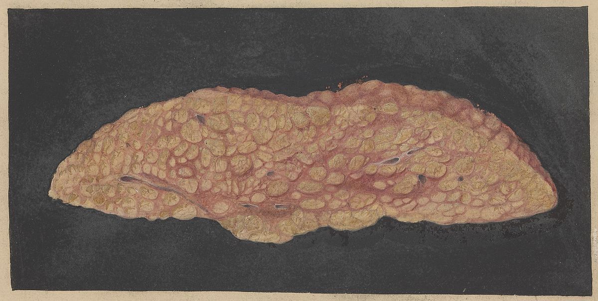 Cirrhotic Liver with Fatty Degeneration SimpleMed Cirrhotic Liver with Fatty Degeneration SimpleMed