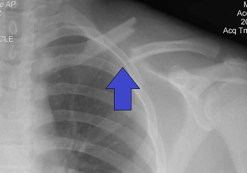 Mid-Clavicular Fracture X-ray SimpleMed Mid-Clavicular Fracture X-ray SimpleMed