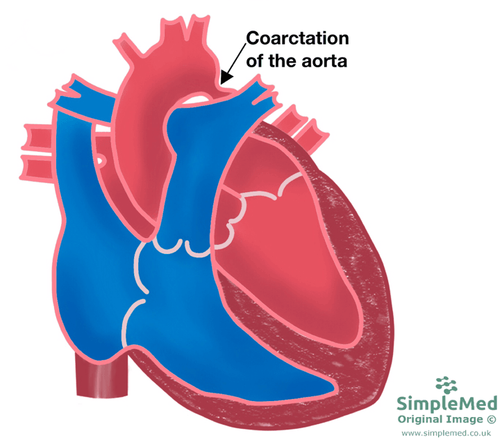 Coarctation of the Aorta SimpleMed Coarctation of the Aorta SimpleMed
