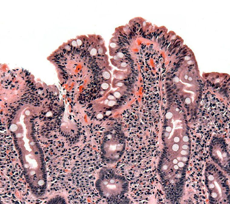 Coeliac Histology with Atrophic Villi SimpleMed Coeliac Histology with Atrophic Villi SimpleMed