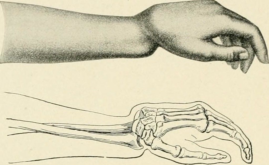 Colle's Fracture SimpleMed Colle's Fracture SimpleMed