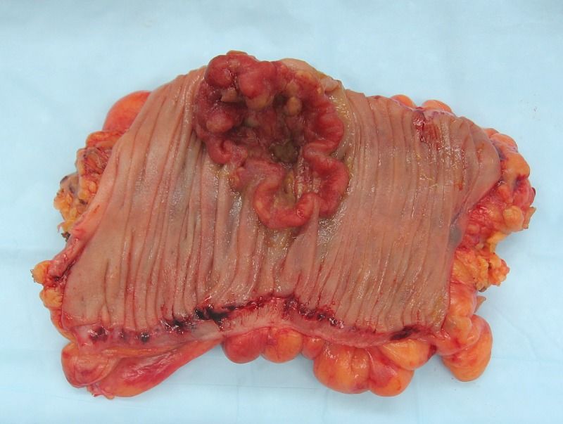 Colorectal Cancer SimpleMed