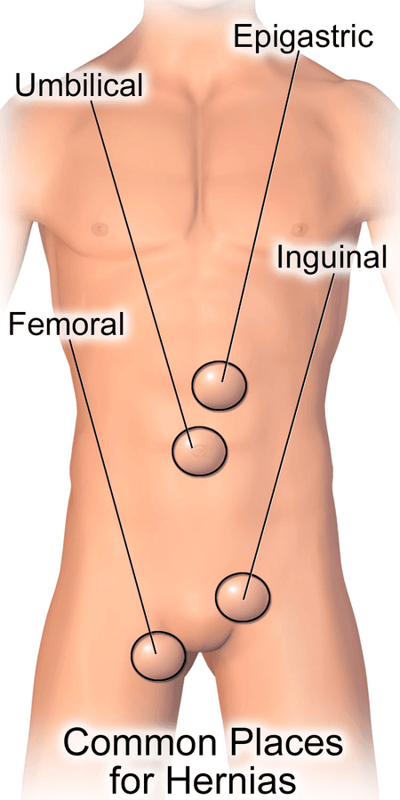 Common Sites of Hernias SimpleMed Common Sites of Hernias SimpleMed