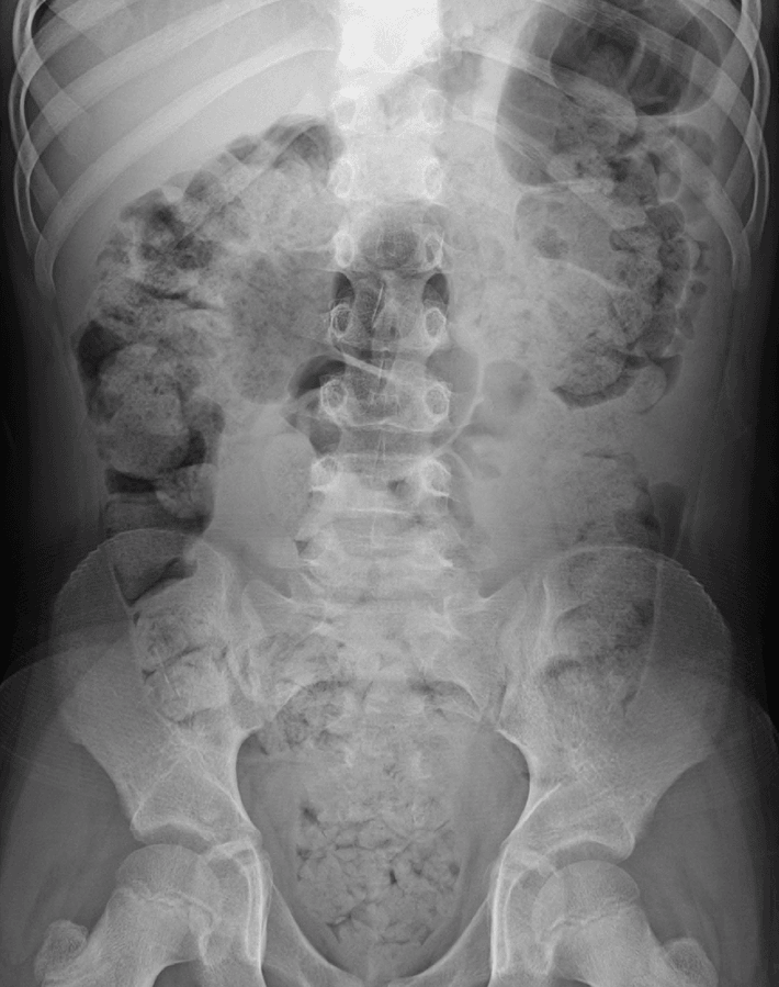 Constipation on an Abdominal X-ray SimpleMed Constipation on an Abdominal X-ray SimpleMed