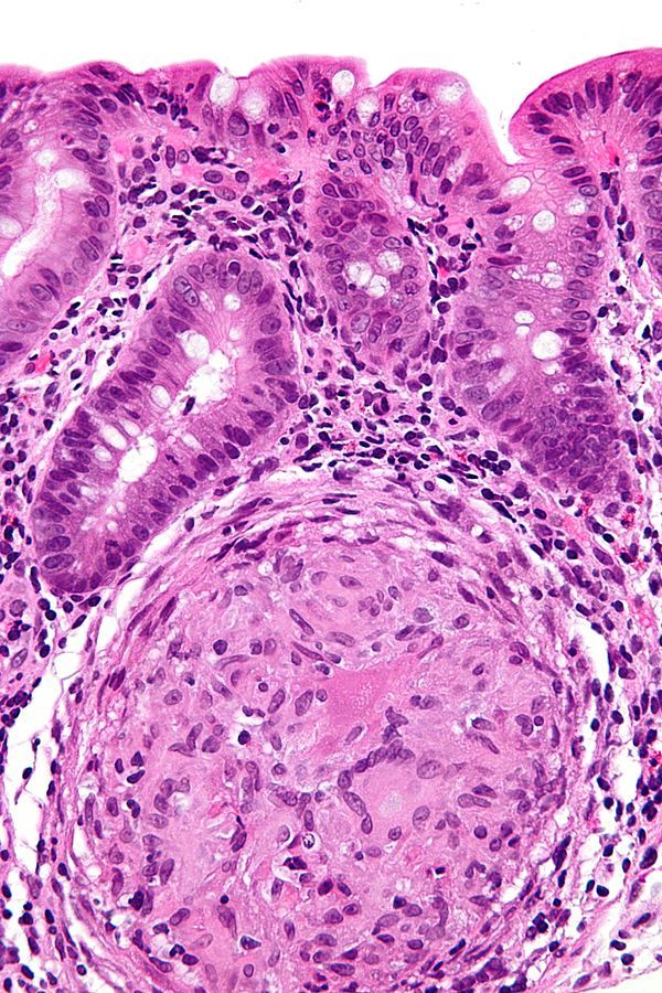Crohn's Disease Histology with Granuloma SimpleMed Crohn's Disease Histology with Granuloma SimpleMed