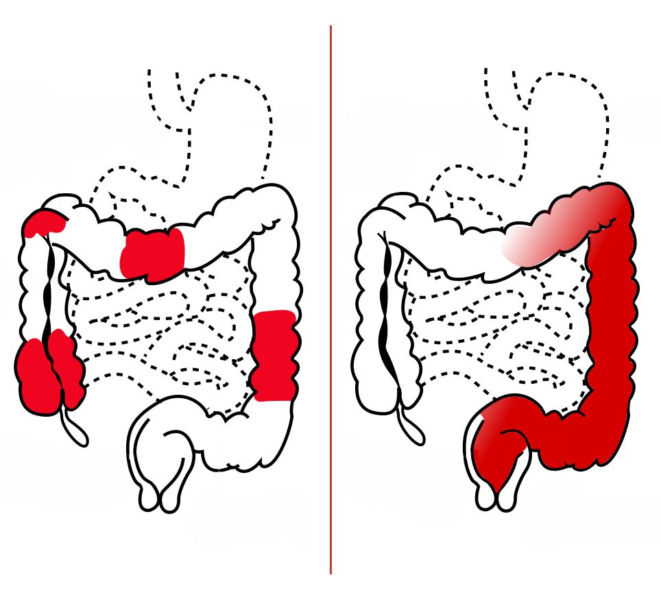 Pattern of Disease in Crohn's vs UC SimpleMed Pattern of Disease in Crohn's vs UC SimpleMed