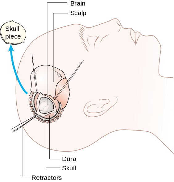 Decompressive Craniectomy SimpleMed