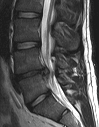 Disc Herniation SimpleMed Disc Herniation SimpleMed