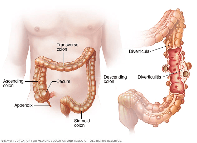 Diverticular Disease SimpleMed Diverticular Disease SimpleMed