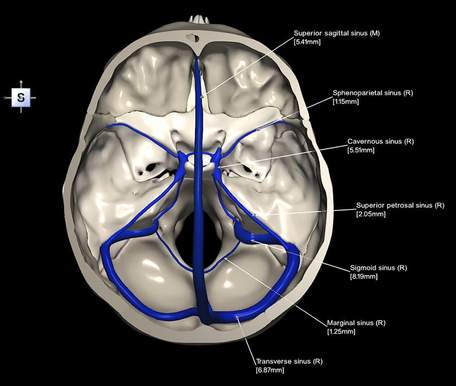 Dural Venous Sinuses SimpleMed Dural Venous Sinuses SimpleMed