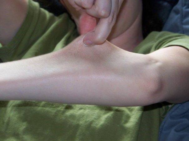 Ehlers Danlos Syndrome Skin SimpleMed Ehlers Danlos Syndrome Skin SimpleMed