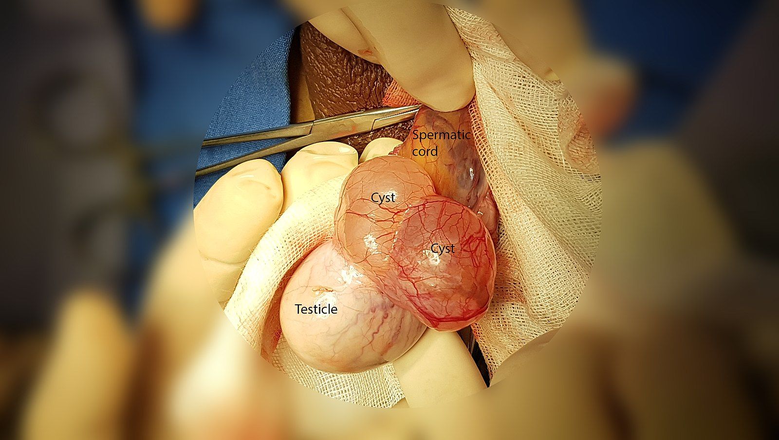 Epididymal Cysts SimpleMed Epididymal Cysts SimpleMed