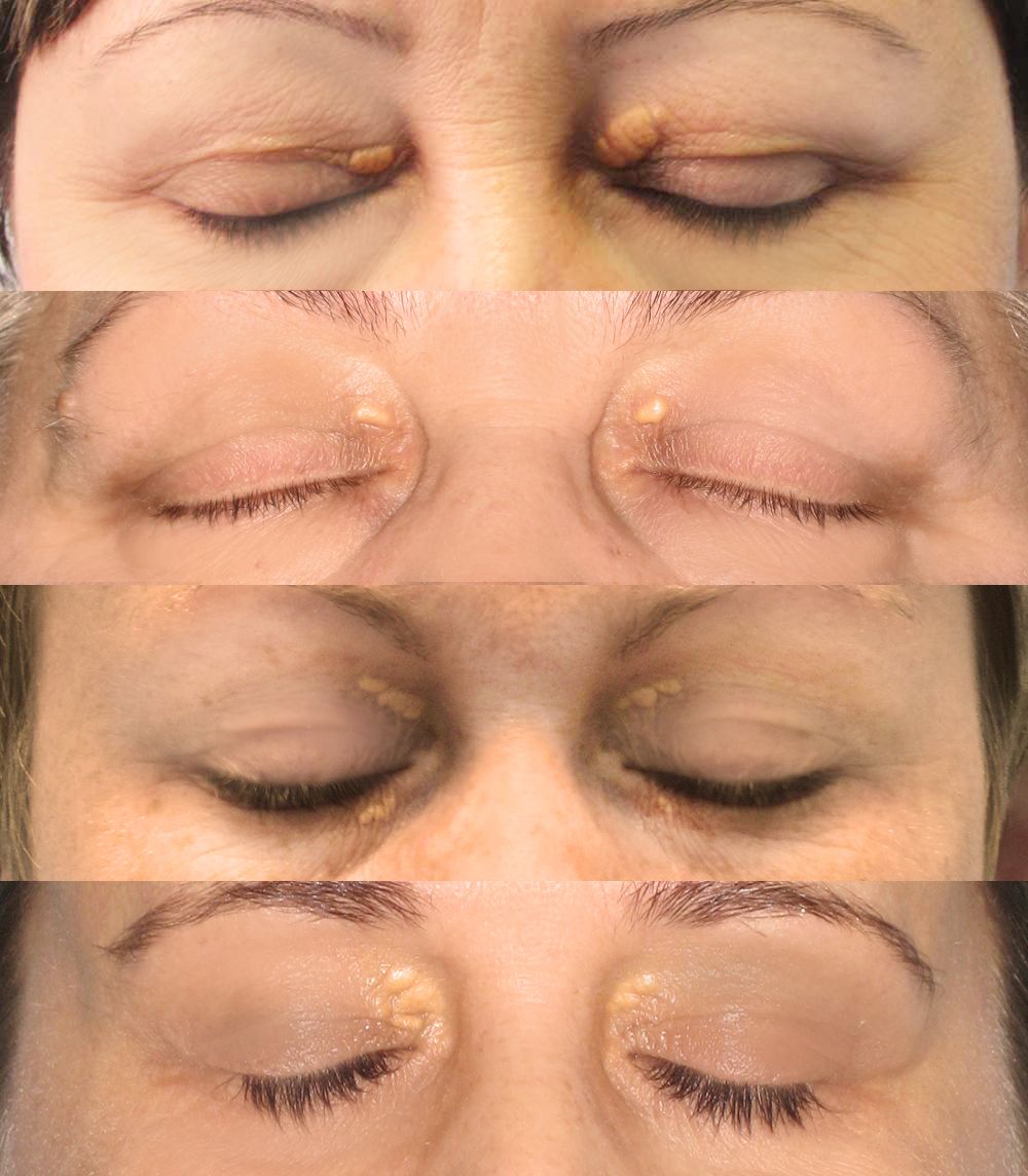 Xanthelasma SimpleMed Xanthelasma SimpleMed