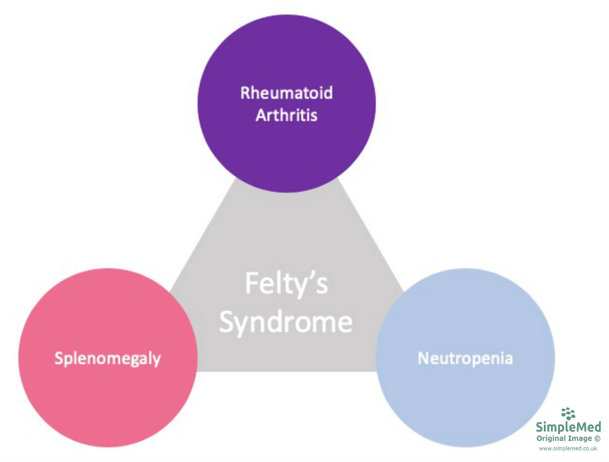 Felty's Syndrome Triad SimpleMed Felty's Syndrome Triad SimpleMed