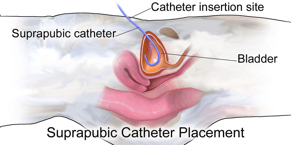Female Suprapubic Catheter SimpleMed Female Suprapubic Catheter SimpleMed