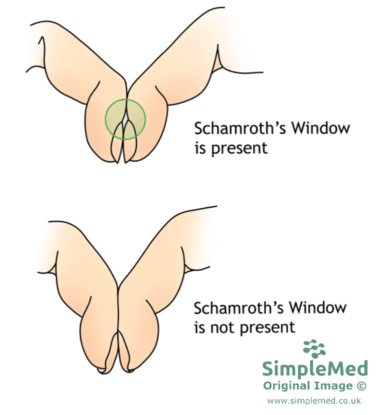 Finger Clubbing SimpleMed Finger Clubbing SimpleMed