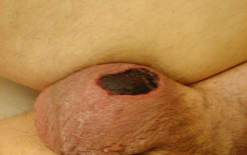Fournier's Gangrene SimpleMed Fournier's Gangrene SimpleMed