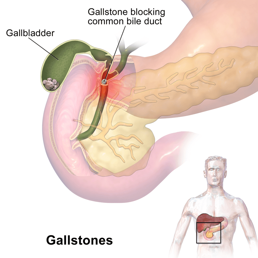 Gallstones Blocking the Common Bile Duct SimpleMed Gallstones Blocking the Common Bile Duct SimpleMed