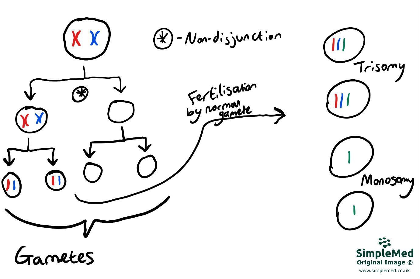 Non-disjunction in Meosis 1 SimpleMed Non-disjunction in Meosis 1 SimpleMed