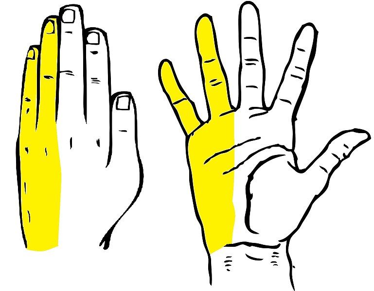 Guyon Syndrome Ulnar Nerve Compression SimpleMed Guyon Syndrome Ulnar Nerve Compression SimpleMed