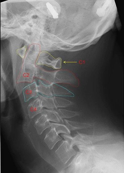 Hangmans Fracture SimpleMed Hangmans Fracture SimpleMed