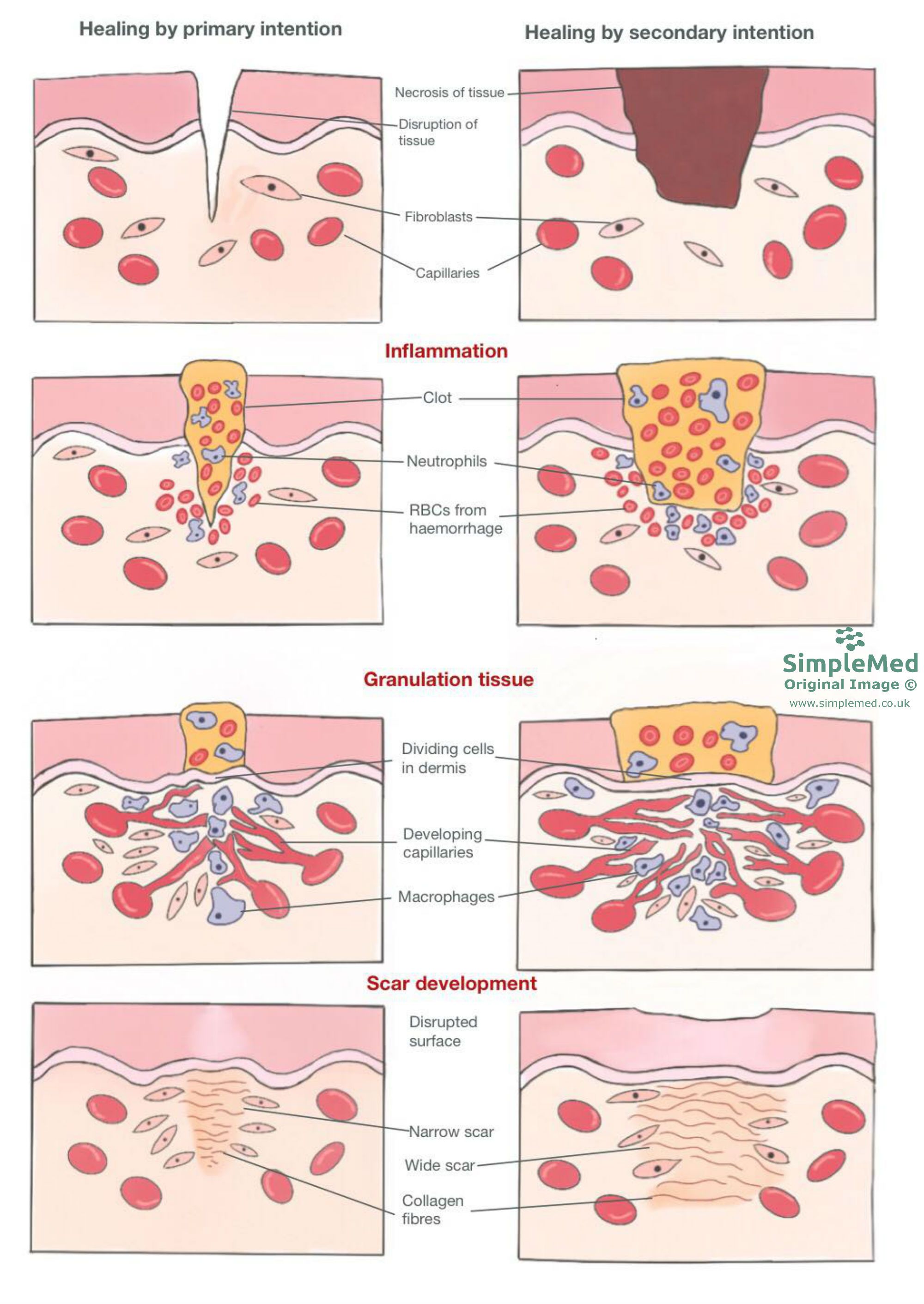 Healing by Primary and Secondary Intention SimpleMed Healing by Primary and Secondary Intention SimpleMed