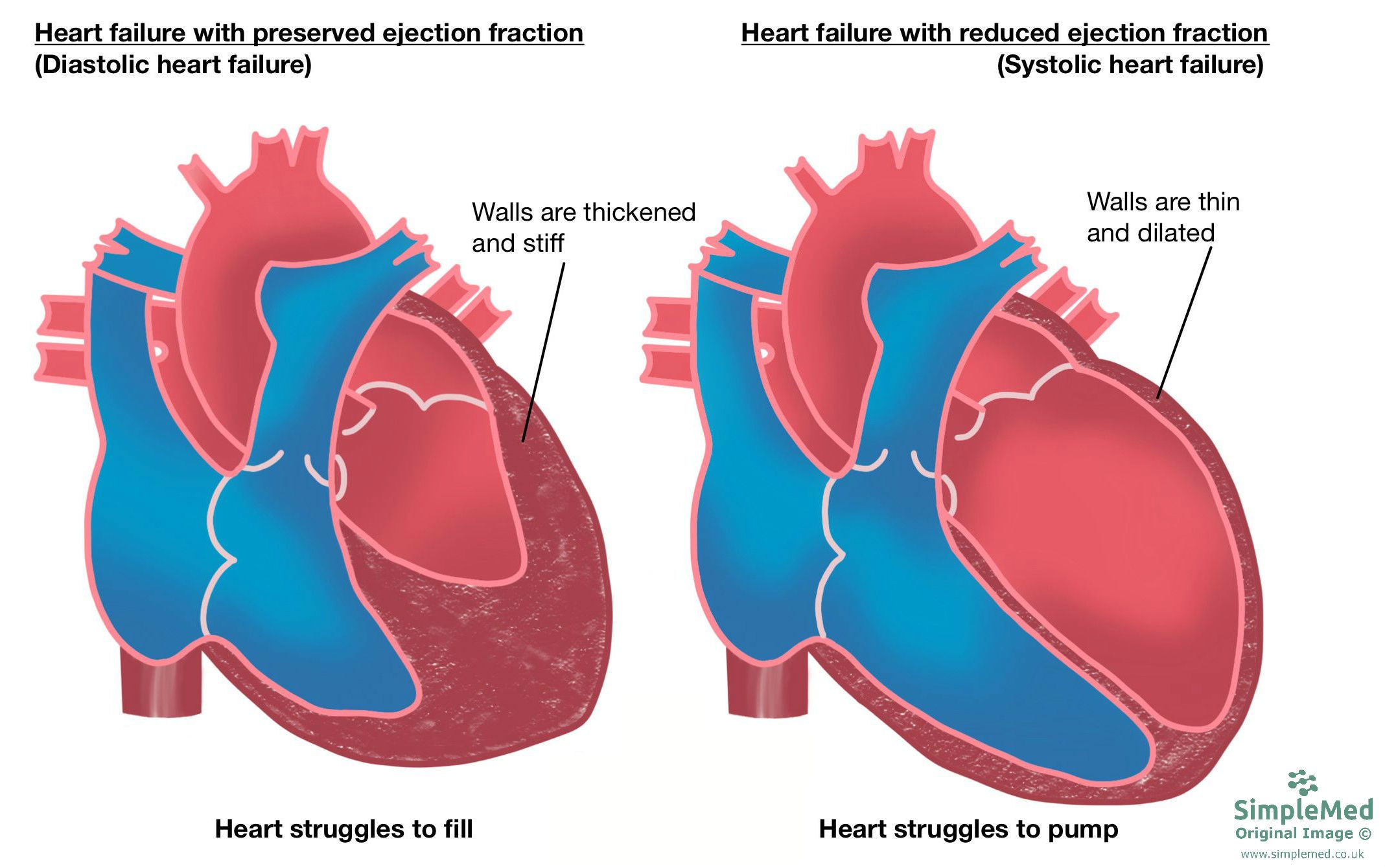 Heart Failure Classification SimpleMed Heart Failure Classification SimpleMed