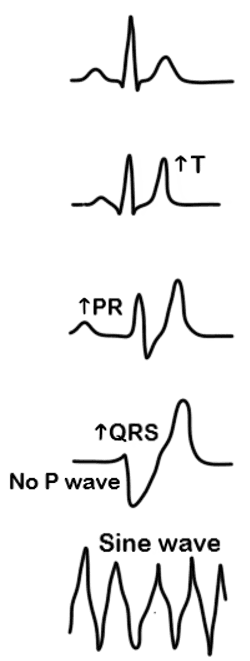 ECG Changes in Hyperkalaemia SimpleMed ECG Changes in Hyperkalaemia SimpleMed