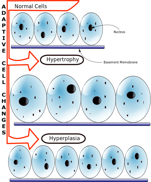 Differences Between Hyperplasia and Hypertrophy SimpleMed Differences Between Hyperplasia and Hypertrophy SimpleMed