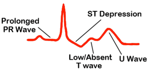 ECG Changes in Hypokalaemia SimpleMed ECG Changes in Hypokalaemia SimpleMed