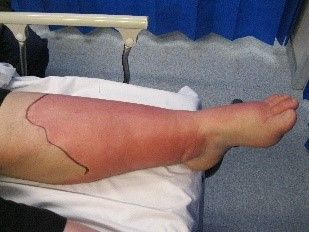 Cellulitis SimpleMed Cellulitis SimpleMed