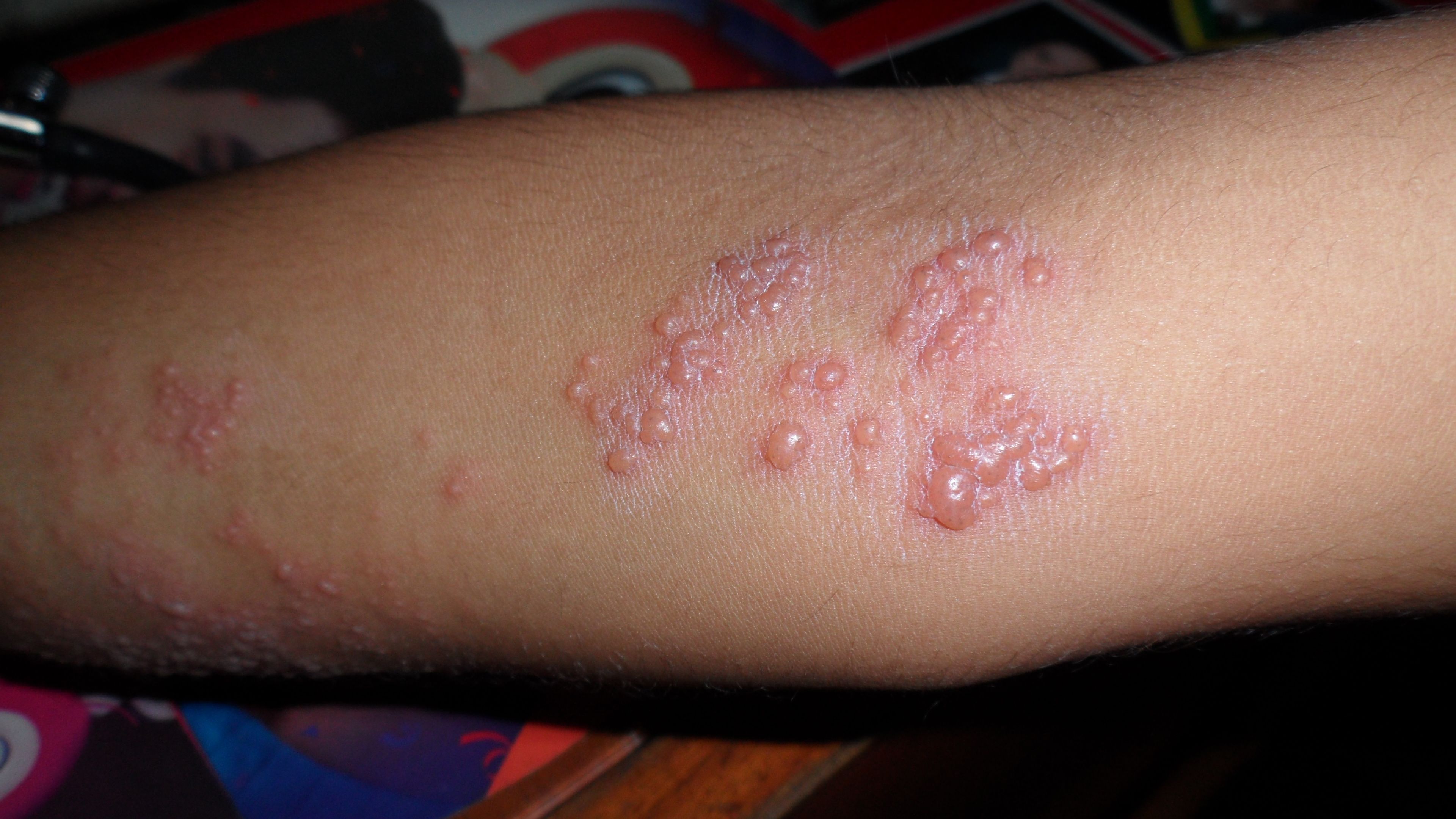 Herpes Zoster Elbow SimpleMed Herpes Zoster Elbow SimpleMed