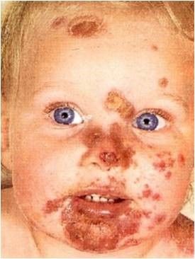Impetigo SimpleMed Impetigo SimpleMed