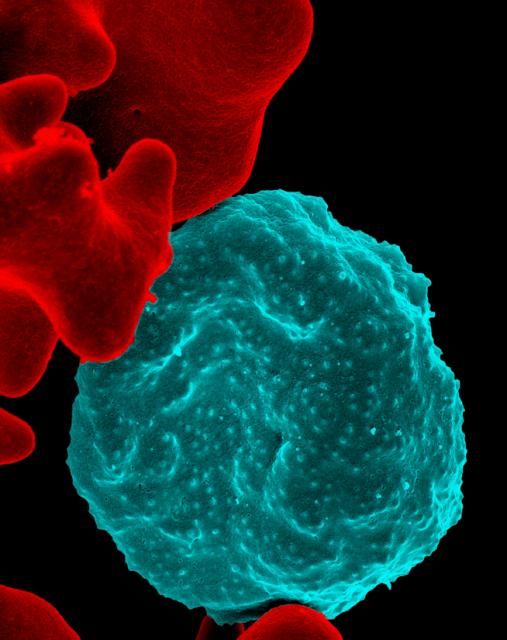 Malaria Infected Red Blood Cell SimpleMed Malaria Infected Red Blood Cell SimpleMed