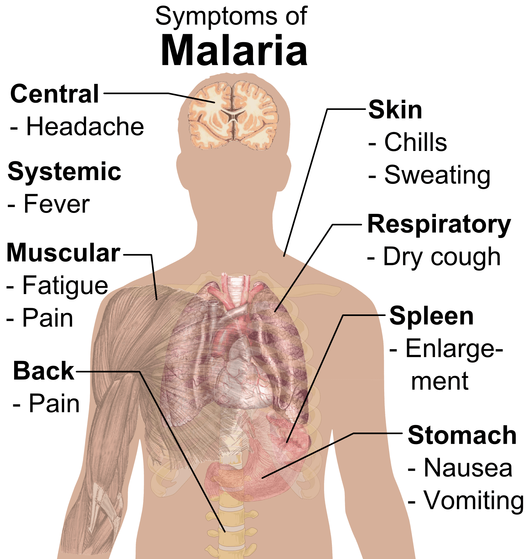 Symptoms of Malaria SimpleMed Symptoms of Malaria SimpleMed