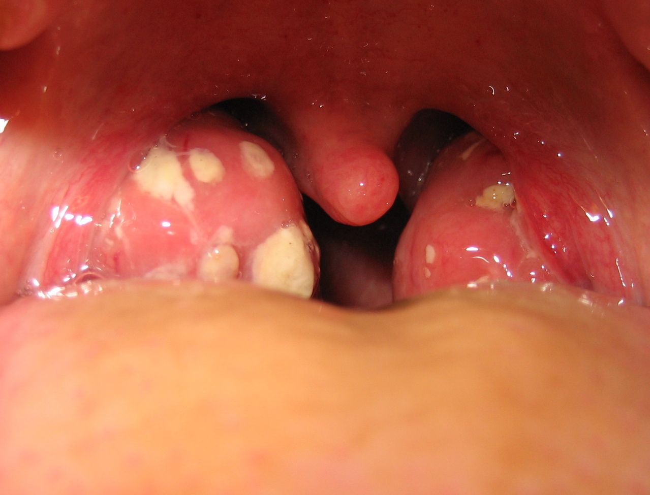 Inflamed Palatine Tonsils (Tonsillitis) SimpleMed Inflamed Palatine Tonsils (Tonsillitis) SimpleMed
