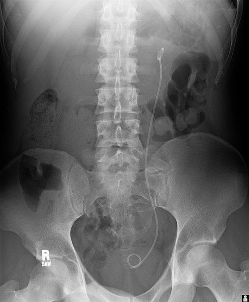 JJ Stent Abdominal X-ray SimpleMed JJ Stent Abdominal X-ray SimpleMed