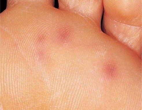 Janeway Lesions SimpleMed Janeway Lesions SimpleMed