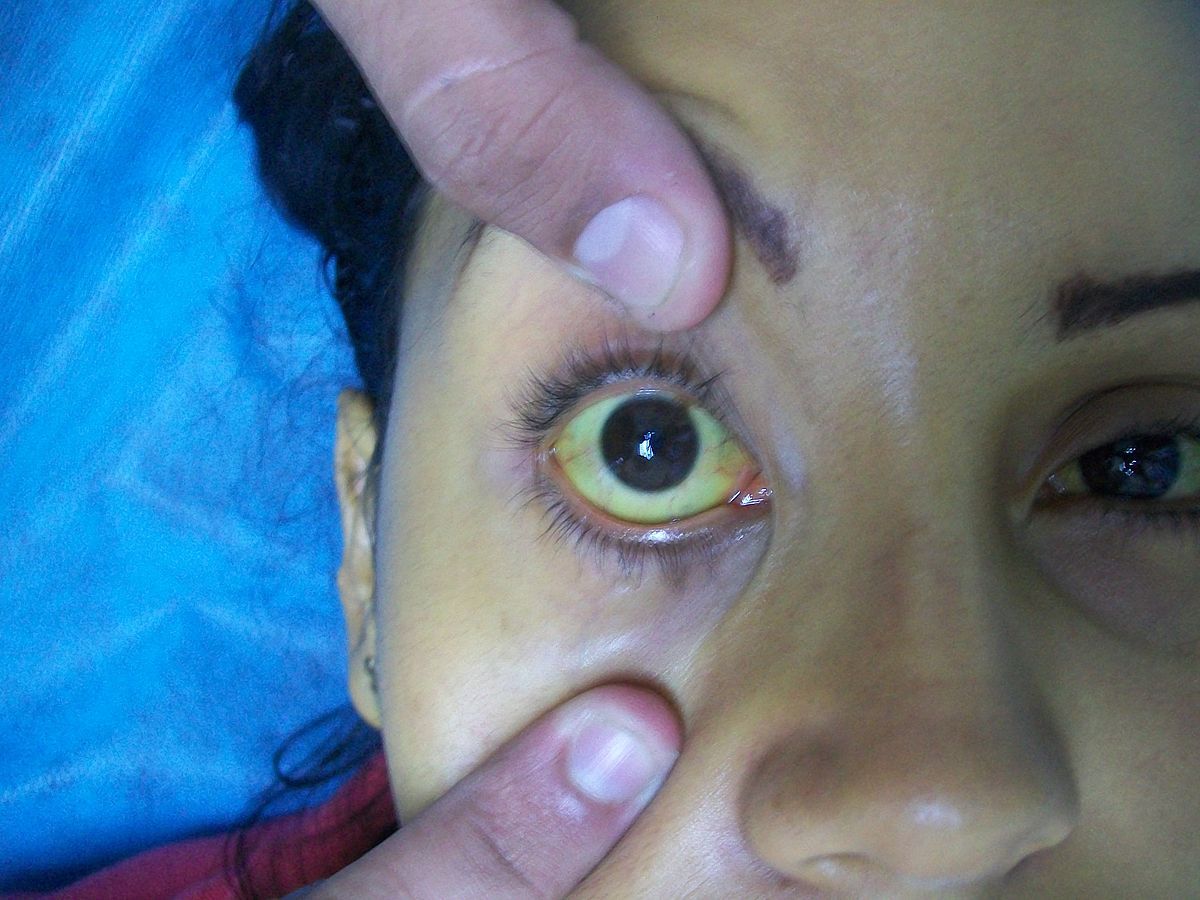 Jaundice of the Sclera SimpleMed Jaundice of the Sclera SimpleMed
