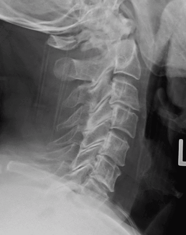 Jefferson's Fracture SimpleMed Jefferson's Fracture SimpleMed