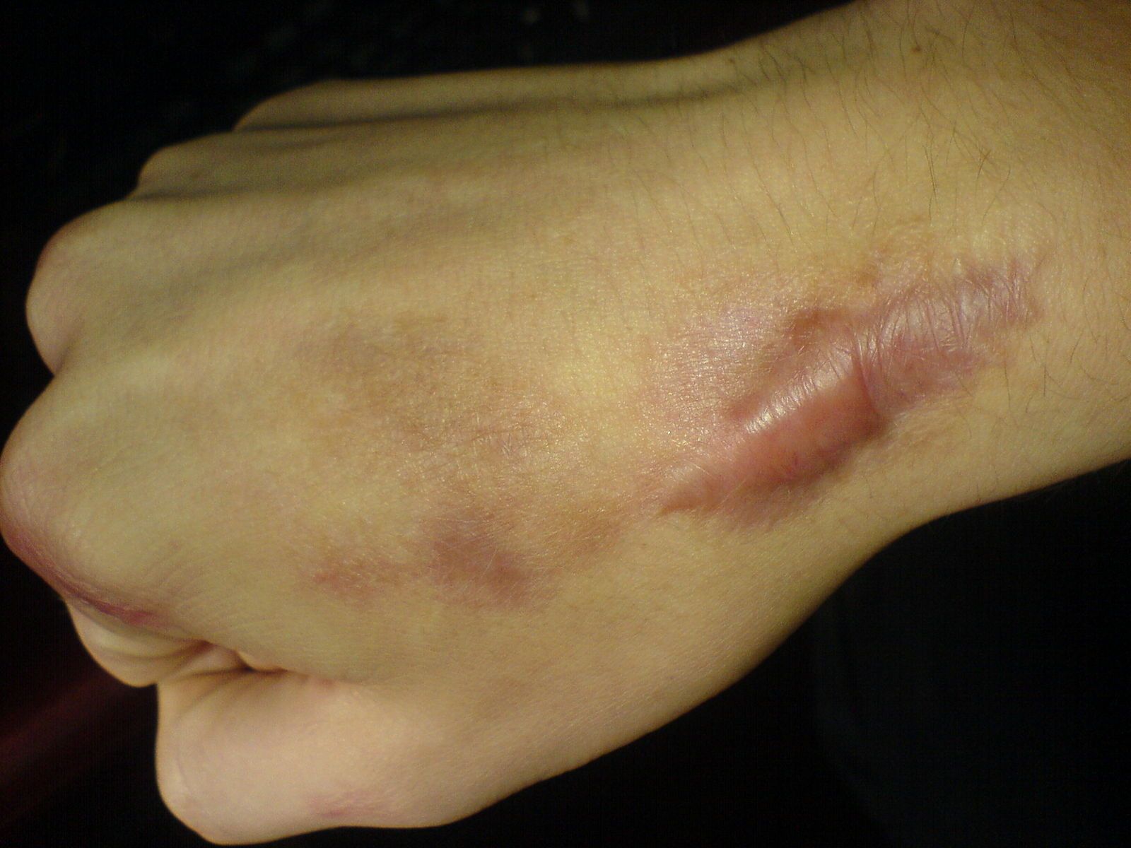 Keloid Scar SimpleMed Keloid Scar SimpleMed