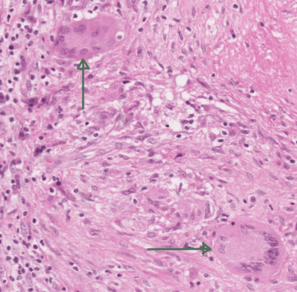 Langhans Giant Cells in TB Granuloma SimpleMed Langhans Giant Cells in TB Granuloma SimpleMed