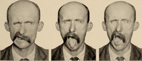 Left Sided Facial Palsy SimpleMed Left Sided Facial Palsy SimpleMed