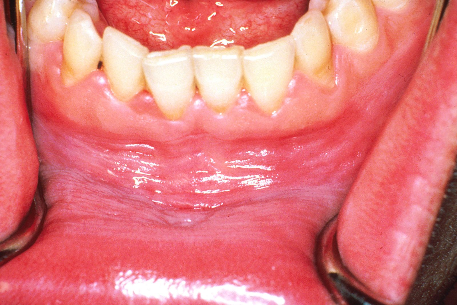 Leukoplakia of Lower Lip and Gum SimpleMed Leukoplakia of Lower Lip and Gum SimpleMed