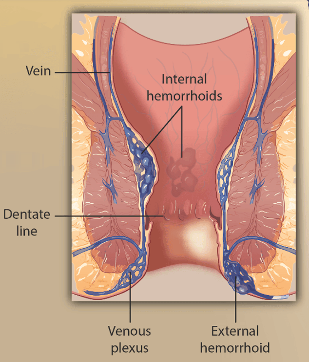 Locations of Haemorrhoids SimpleMed Locations of Haemorrhoids SimpleMed