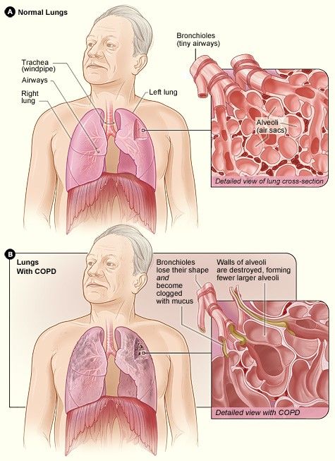 Lungs with COPD vs Lungs without COPD SimpleMed Lungs with COPD vs Lungs without COPD SimpleMed