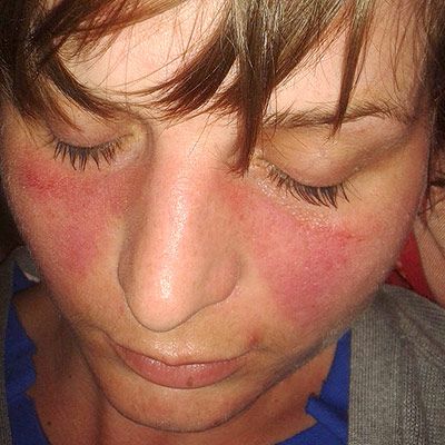 Malar Rash SimpleMed Malar Rash SimpleMed