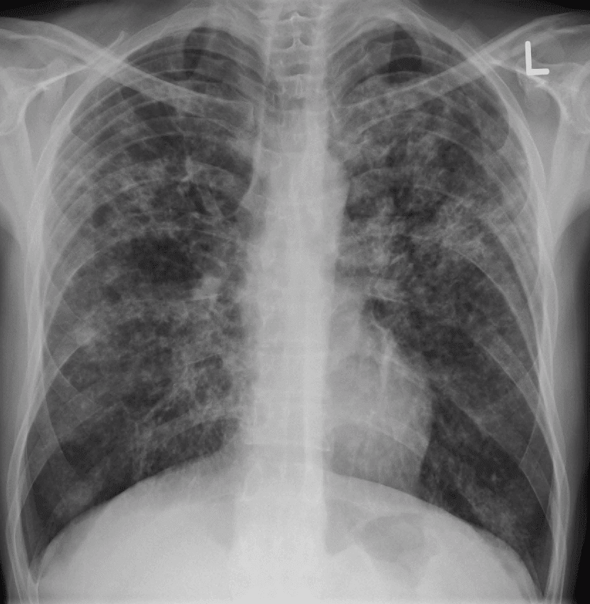 Miliary Tuberculosis Chest X-ray SimpleMed Miliary Tuberculosis Chest X-ray SimpleMed