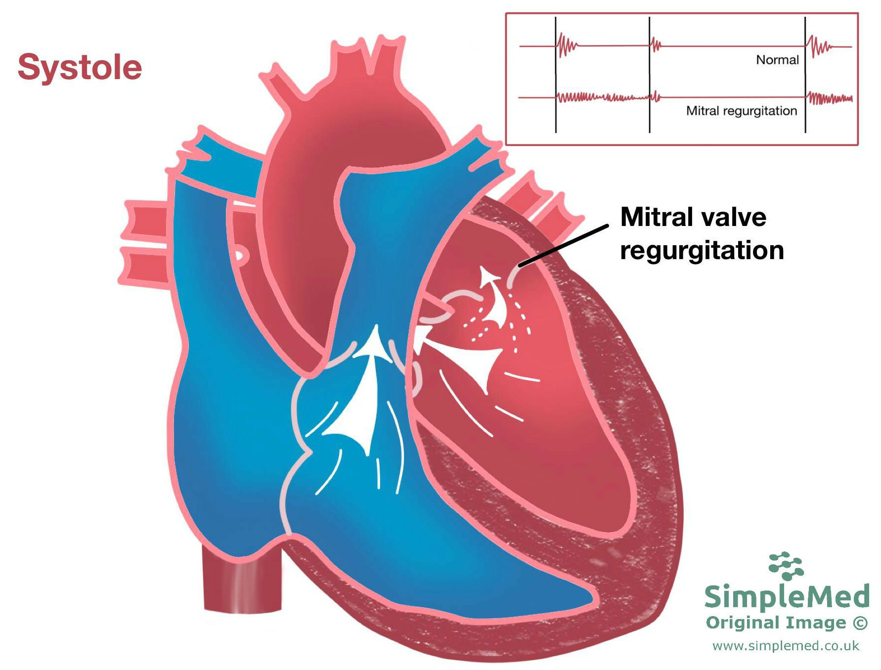 Mitral Valve Regurgitation SimpleMed Mitral Valve Regurgitation SimpleMed